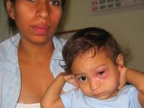 Chagas-Krankheit bricht in Guairá aus