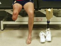 Amputationen: Motorradunfälle und Diabetes liegen ganz vorne