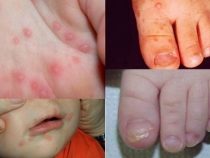 Ein Virus breitet sich aus