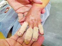 Immer mehr Kinder verbrühen sich durch heißes Wasser