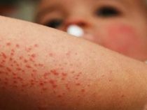 Masern schlimmer als Coronavirus