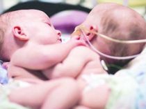 Siamesische Zwillinge: Zweites Baby, das die Trennungsoperation überlebt hatte, stirbt