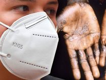 Affenpocken: Bürger sollen Maske wieder verwenden