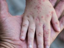 Impfoffensive in Schulen: Kampf den Masern