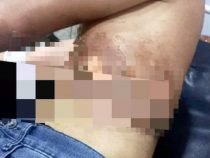 Handy am Netz verursacht Verbrennungen an jungem Mann