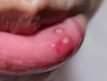 Konsultationen wegen Herpes bei Kindern steigen deutlich an