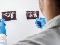 1 Todesfall pro Tag: Experte warnt vor langsamer, aber teurer Entwicklung des Prostatakrebs