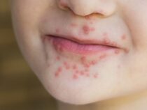 Anstieg der Fälle von “Hand-Fuß-Mund-Krankheit“ in Itapúa: Behörden mahnen zur verstärkten Kinderhygiene