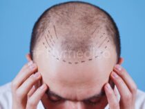 Methoden der Haarverpflanzung im Vergleich – FUE, FUT und DHI erklärt