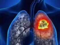 Rauchen, Brennholz und Vaping: Die Auslöser für den Lungenkrebs-Anstieg in Paraguay