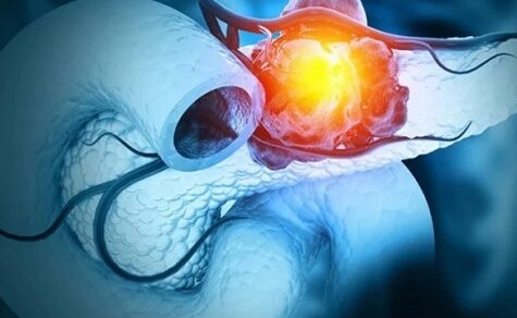 3-Drogen-Mix gegen Bauchspeicheldrüsenkrebs – Forscher Antonio Cubilla erklärt die neue Hoffnung aus Spanien