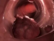 Tödliche Gefahr im Darm: Immer mehr junge Menschen in Paraguay erkranken