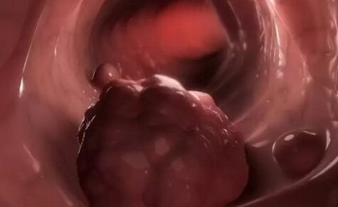 Tödliche Gefahr im Darm: Immer mehr junge Menschen in Paraguay erkranken