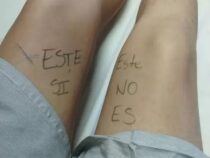 Junge Frau markiert ihr Bein vor der Operation, um einen medizinischen Fehler zu vermeiden