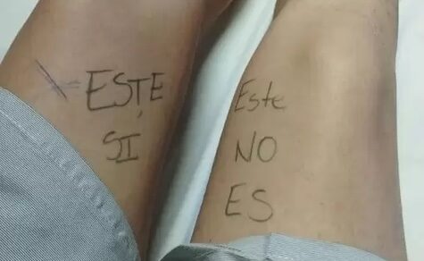 Junge Frau markiert ihr Bein vor der Operation, um einen medizinischen Fehler zu vermeiden