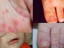 Gefährlicher Winter-Virus grassiert: Was Eltern jetzt unbedingt beachten müssen