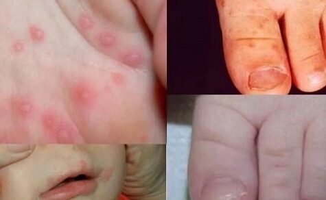 Gefährlicher Winter-Virus grassiert: Was Eltern jetzt unbedingt beachten müssen
